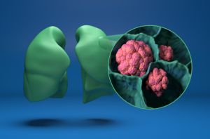 Lung cancer (LC)
